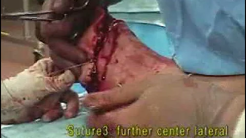 Transmetatarsal Amputation - Total