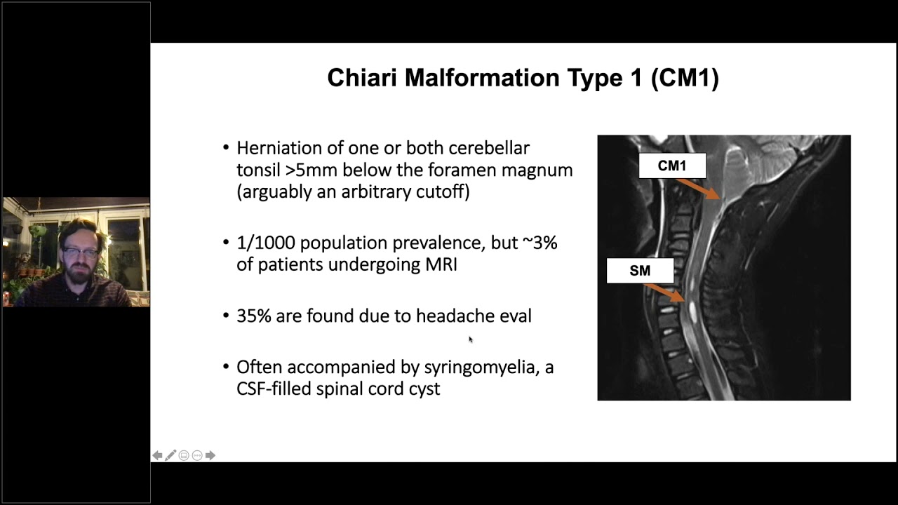 Ask the Expert: Dr. Gabriel Haller on The Genetics of Chiari I Malformation