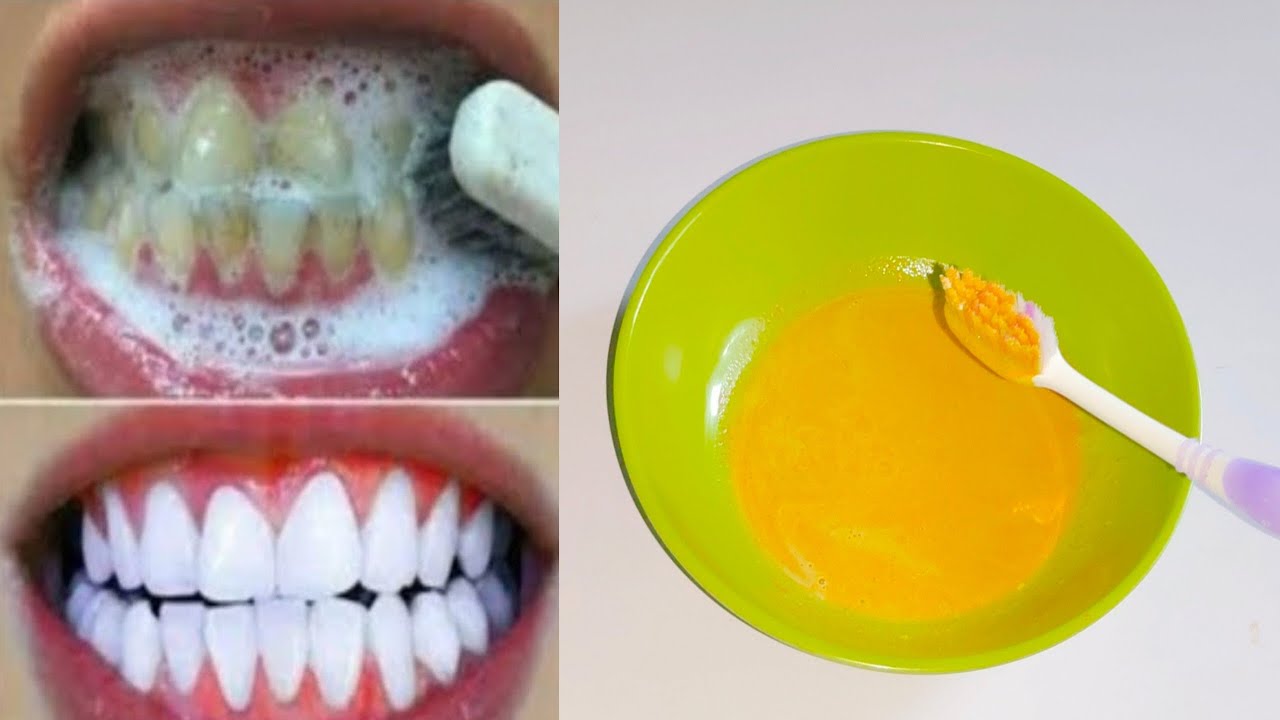 Magical teeth whitening at home instantly Teeth whitening home remedy