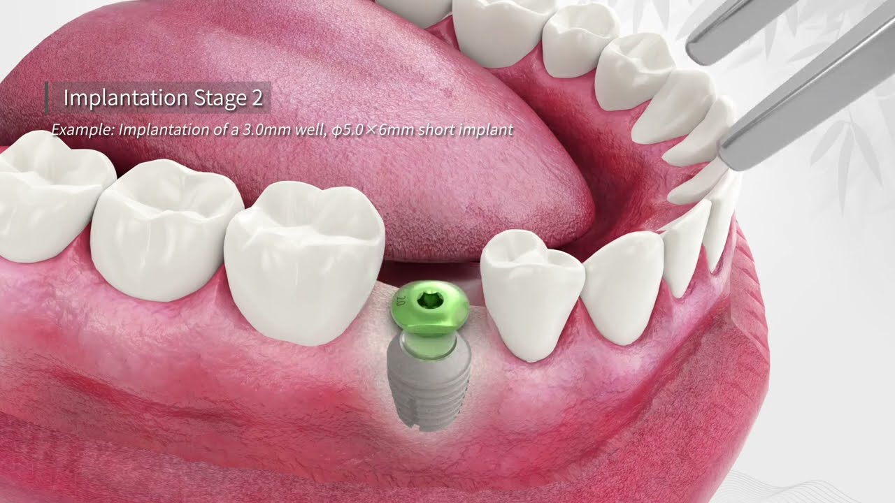 EASYLEARN Implants – Innovative Short Implant Solution