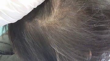 SMP Density Restoration Scalp Micropigmentation by El Truchan @ Scalp Micro Definition