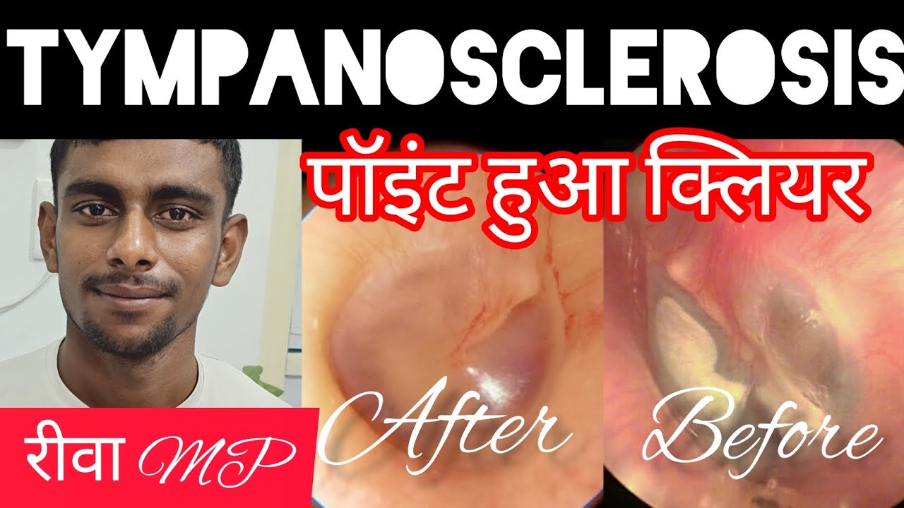 tympanosclerosis यानी पर्दे पर सफेद चकक्ता या दाग; दूरबीन द्वारा सफल
