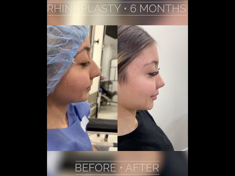 Video thumbnail: 4D Nose Approach - 6 Months After Rhinoplasty | As Seen On Instagram & TikTok — Dr. Anil Shah
