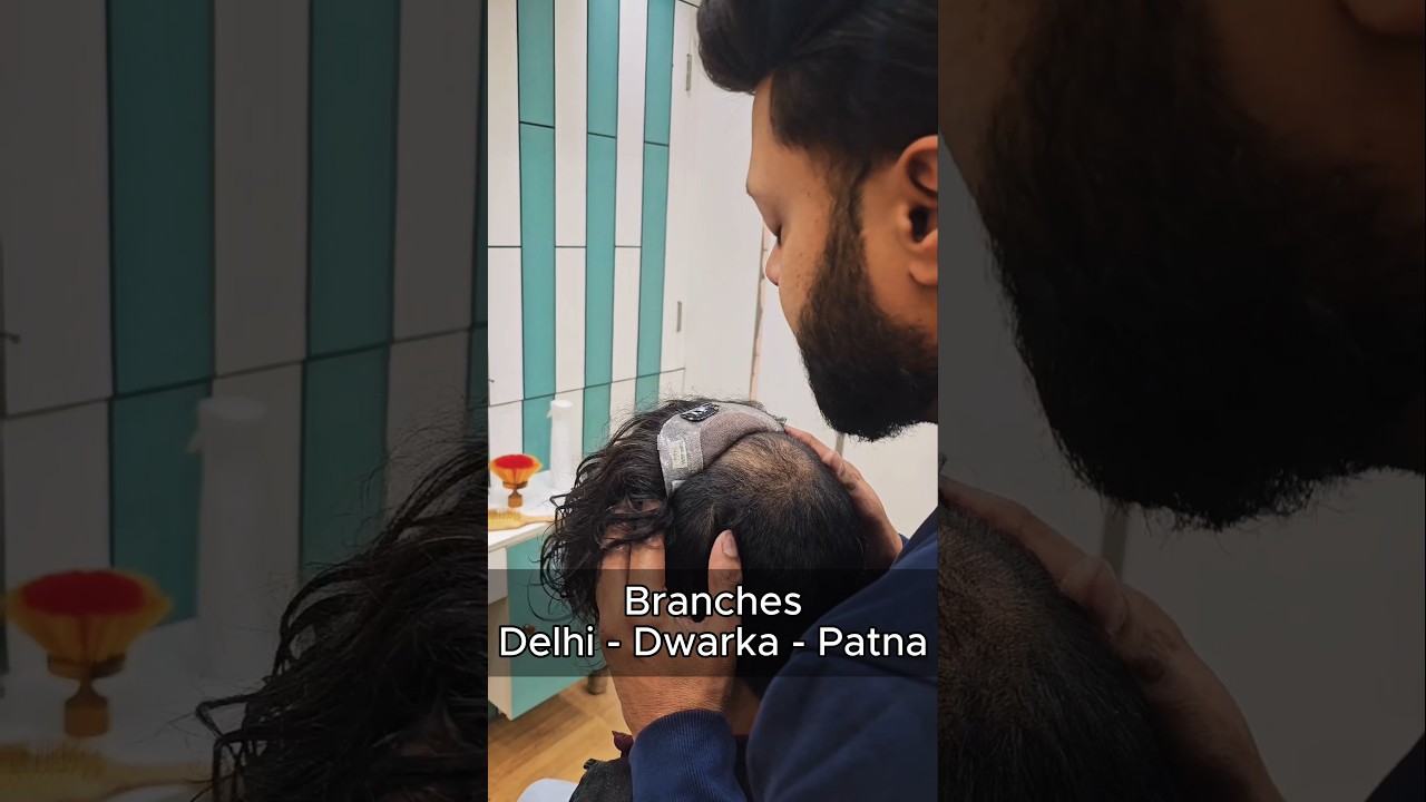 Premium Clipping Hair Patch for Men | Real Before & After Results 