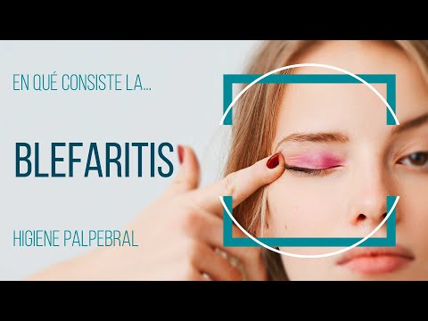 Video: ¿Cuándo la blefaritis no desaparece?