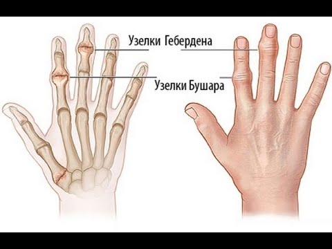 Узлы гебердена на пальцах рук как