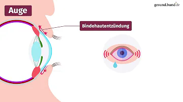 Wie lange sind Kinder mit Bindehautentzündung ansteckend?