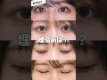 【Before・After】二重埋没法