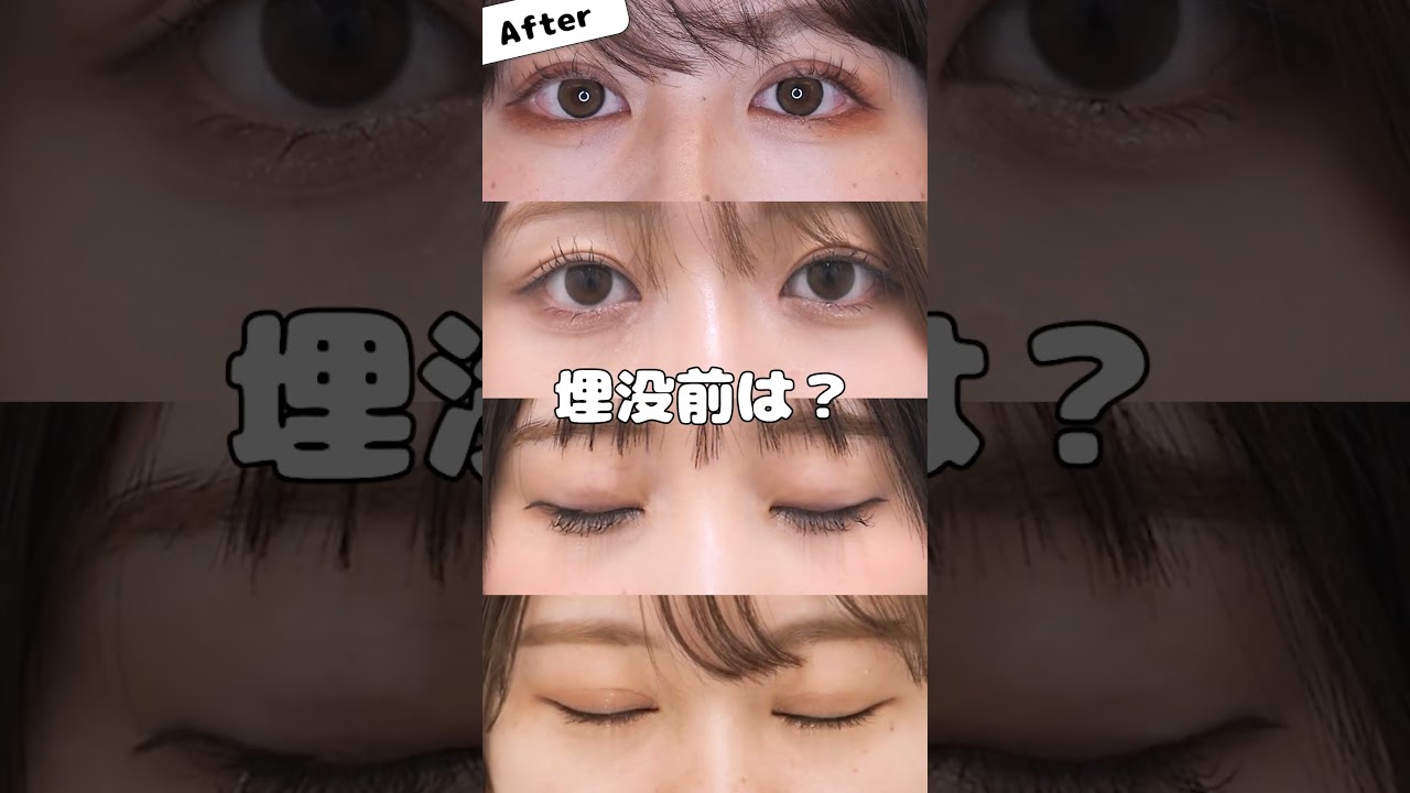 【Before・After】二重埋没法