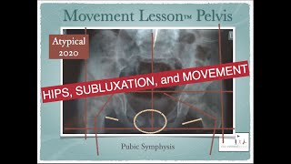 Hips, Subluxation, and Movement