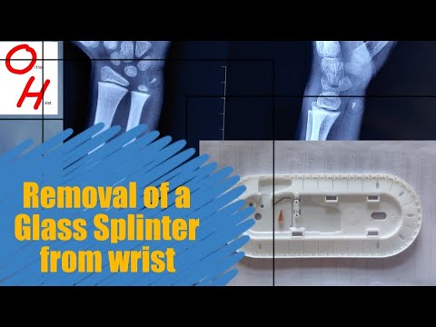 Removal of a Splinter (Glass Piece) from a child's wrist. - YouTube