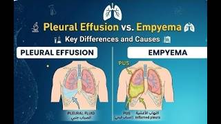 Pleural effusion vs empyema#chest #terminology #pharmacy #medical#course