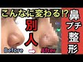 【鼻プチ整形】こんなに変わる！？別人級 ヒアルロン酸・糸・ボトックス