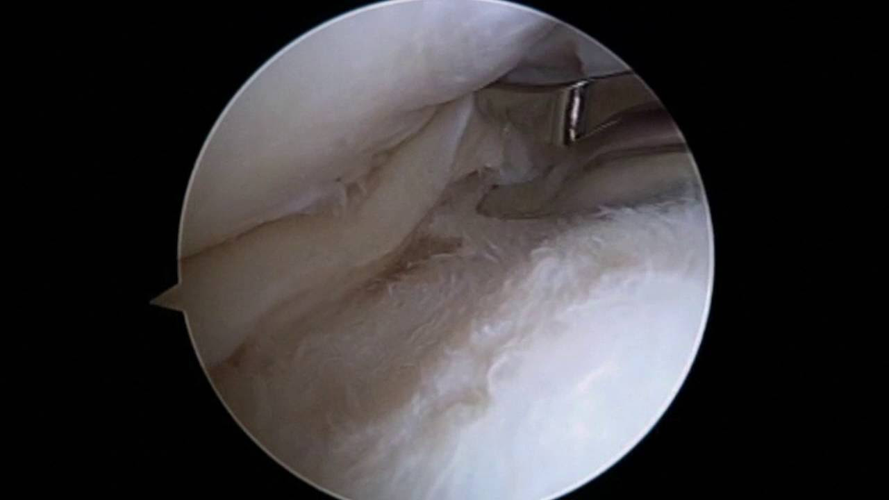 Arthroscopic Partial Meniscectomy of Bucket Handle Lateral Meniscus Tear