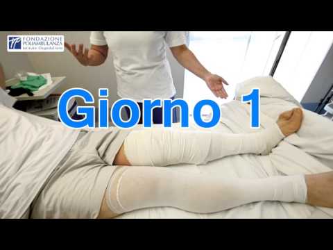 Video: Gonartrosi Del Ginocchio Di 3 ° Grado: Trattamento, Riabilitazione Dopo L'intervento Chirurgico
