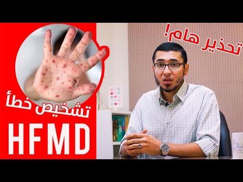متلازمة الفم والكفين والقدمين دكتور محمد جمال