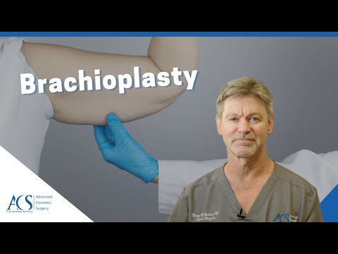 Video: Brachioplasty inamaanisha nini?