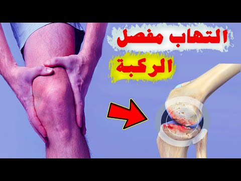ما هو علاج التهاب مفصل الركبة