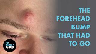 Dr Pimple Popper vs The Forehead Bump That Had To Go