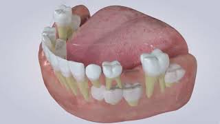 Lower Lingual Holding Arch Pedodontics Denvak