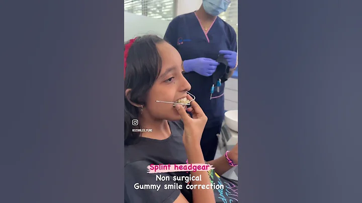 #Splint headgear for gummy smile correction  in growing patients #32smilespune