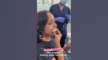 #Splint headgear for gummy smile correction  in growing patients #32smilespune