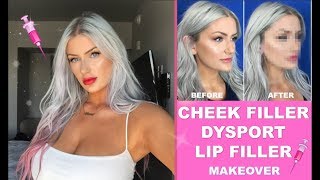 ✨ THE RESULTS ARE INSANE 😱 I GET CHEEK FILLER & DYSPORT for the first time 💓