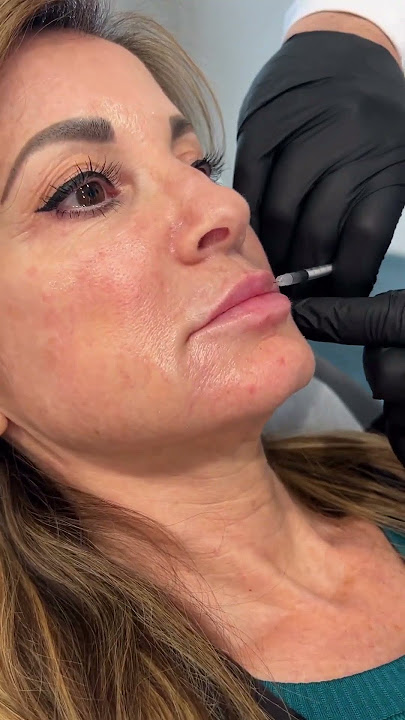 Download lagu Natural Lip Filler Results Using Restylane Kysse 🔥💉