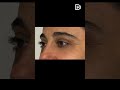 Poches sous les yeux : 3 techniques pour un regard frais | Dr Hayot Paris