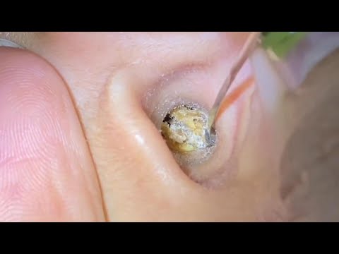 ASMR Ear Cleaning – You Won’t Believe What Was Blocking This Ear