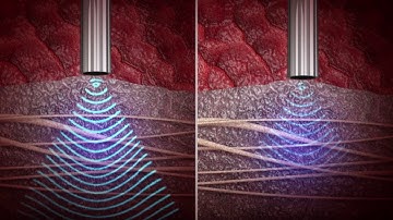 CUSA Clarity Precision Handpiece
