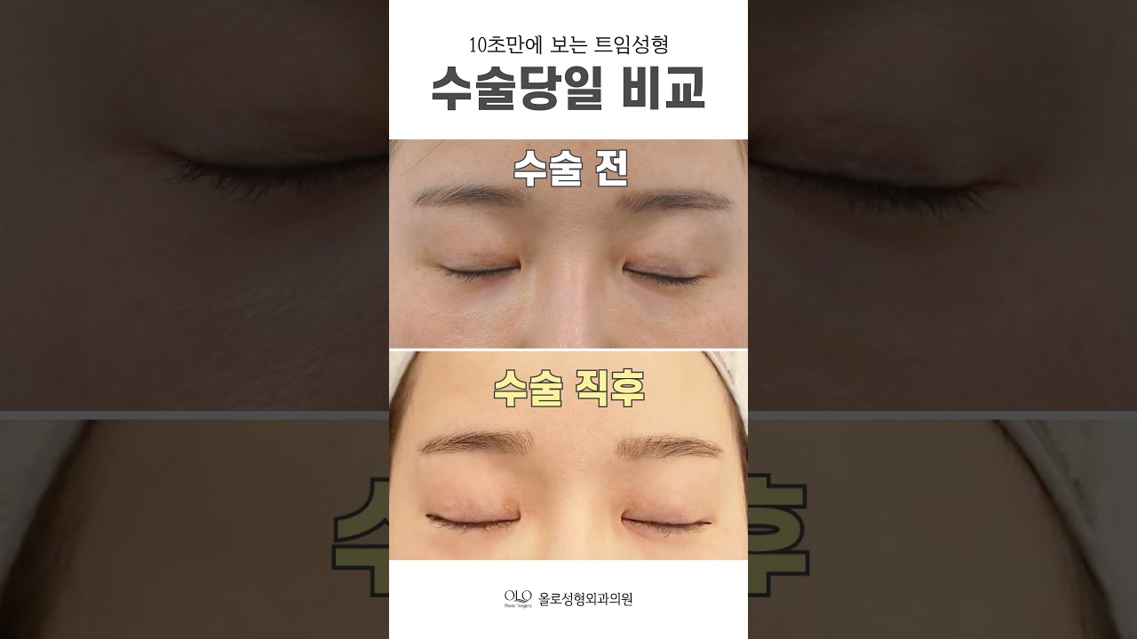 [奧洛整形外科診所] #開眼角整形 當日對比展示！ 只需10秒，請專注！ #shorts
