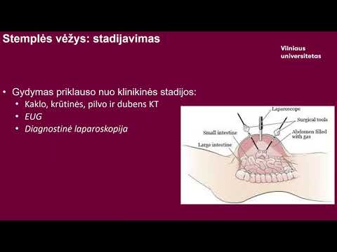 Video: Į Limfoepitheliomą Panaši Skrandžio Karcinoma: Atvejo Ataskaita Ir Literatūros Apžvalga