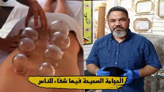 علاج عرق النسا بالحجامة