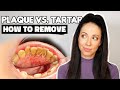 Plaque vs. Tartar | How To Remove Plaque From Teeth At Home