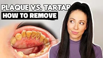 Can you remove hard plaque at home?