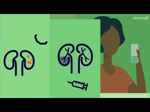 Kidney Stone Overview and More