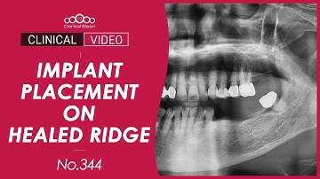 #34, 36 Implant placement on healed ridge [Dr. Jeon Inseong]
