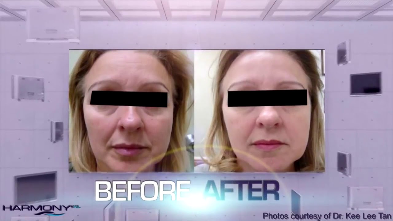 ClearLift laser In the News!