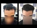 FUE Hair Transplant (2200 Grafts in NW-lll Pattern), Dr. Juan Couto - FUEXPERT CLINIC- Madrid, Spain