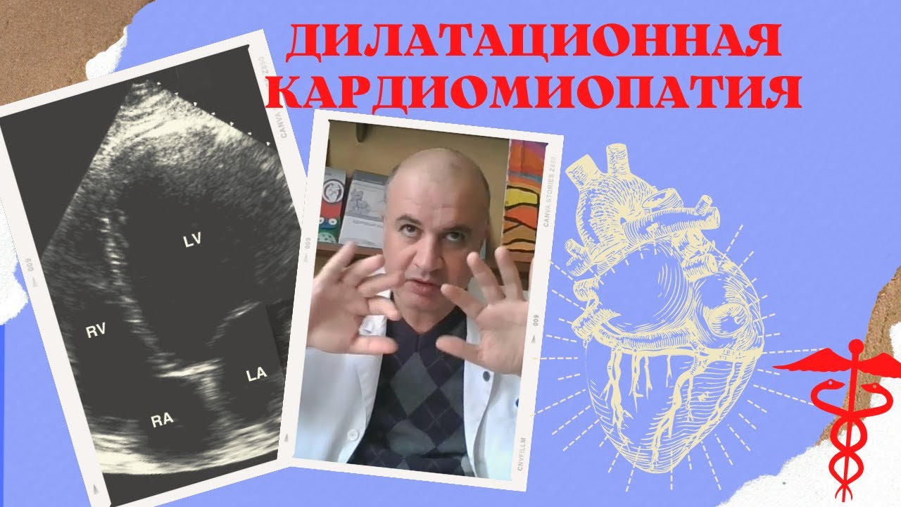 Дилатационная кардиомиопатия (ДКМП). Почему растягивается сердце? - YouTube