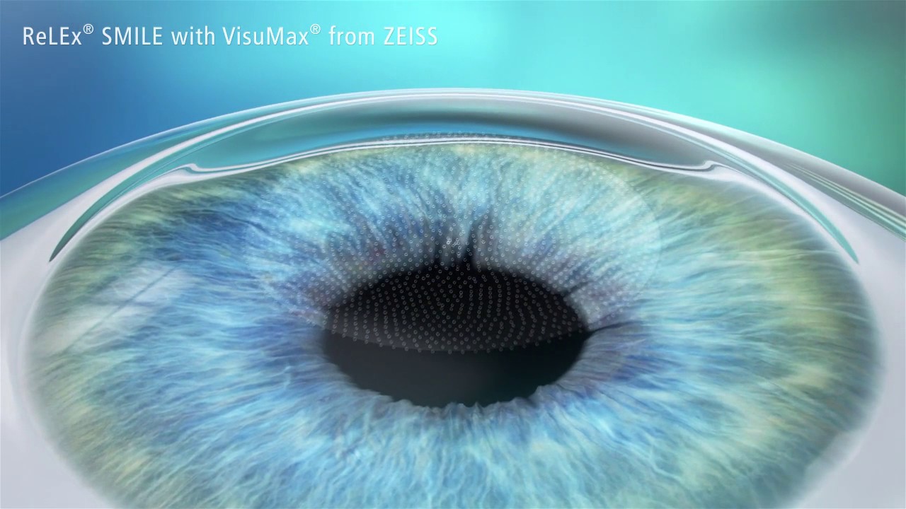 Visumax SMILE - YouTube