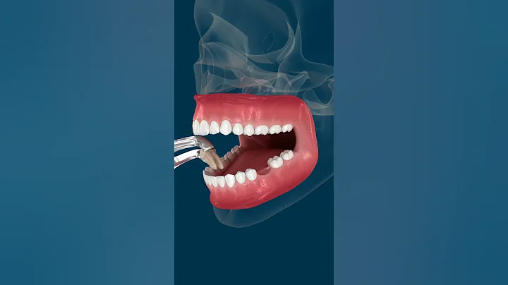 Teeth shift deformation after losing a tooth