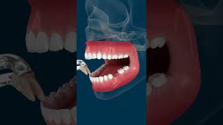 Teeth Shift Deformation After Losing A Tooth