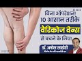10 non surgical treatment options for varicose veins  dr amol lahoti