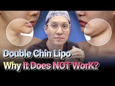 Essential Guide to Double Chin Revision Surgery | Mine Plastic Surgery