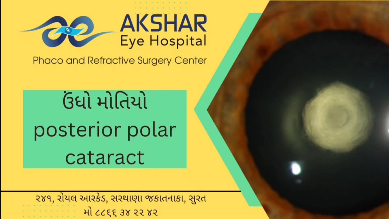 what is posterior polar cataract? how its surgery is different? what ...
