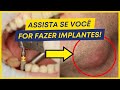 Quais são os cuidados básicos após implante dentário?