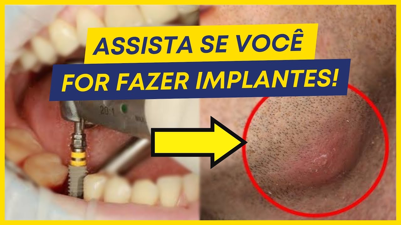 Quais são os cuidados básicos após implante dentário? - YouTube