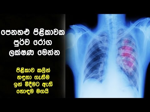 පෙනහළු පිළිකාවක පුර්ව රෝග ලක්ෂණ - 20 Warning Signs Of Lung Cancer